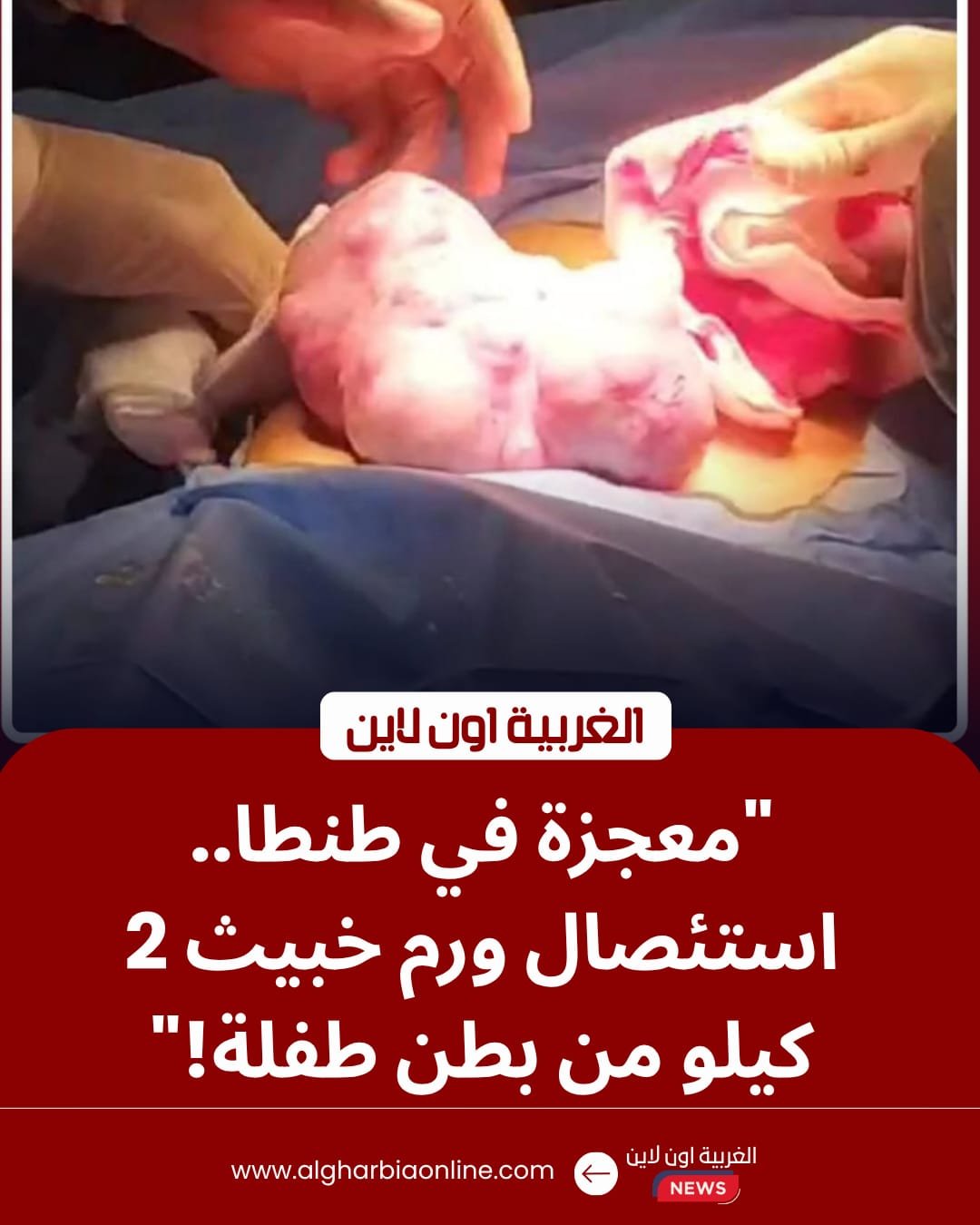 إنجاز طبي في الغربية.. استئصال ورم يزن 2 كجم بمستشفى سرطان الأطفال بجامعة طنطا